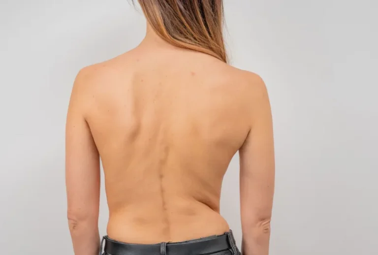 Rückenansicht einer jungen Frau mit Skoliose – sichtbare Wirbelsäulenverkrümmung, wie sie in der Skoliosetherapie nach Schroth gezielt behandelt wird