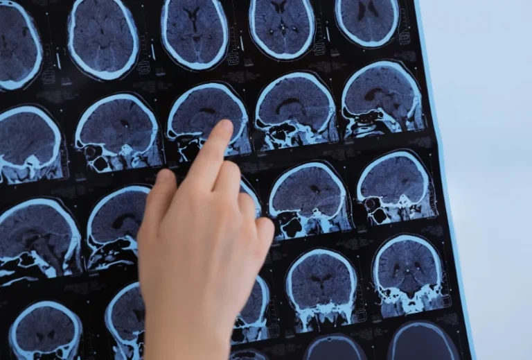 Nahaufnahme einer Hand, die auf MRT-Scans eines Gehirns zeigt – diagnostische Bildgebung zur Erkennung von Multiple Sklerose (MS) und neurologischen Veränderungen.